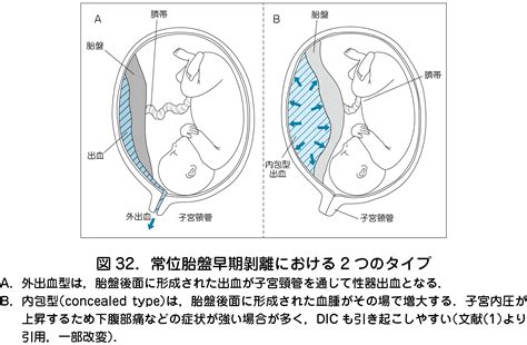 胎盤剝離後期|1．常位胎盤早期剝離（じょういたいばんそうきはく。